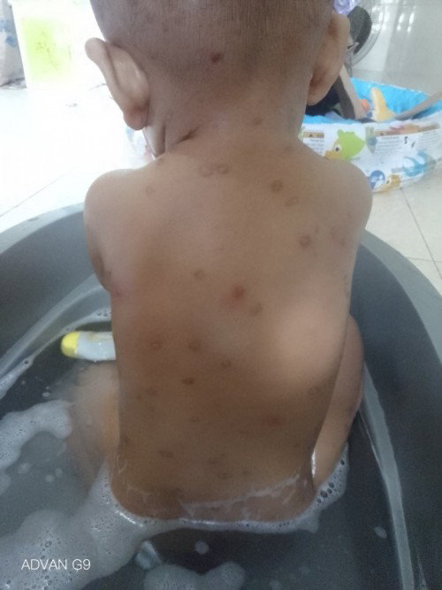 Penyakit kulit pleva