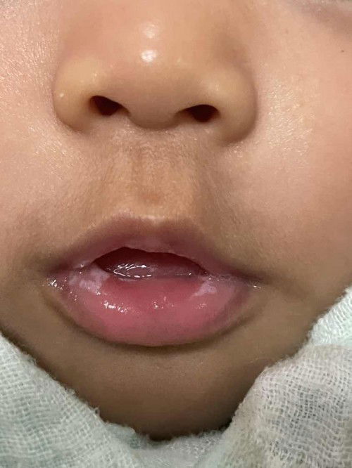 สอบถามลูกมีคราบขาว