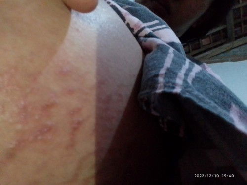 Gatal saat hamil 8 bulan