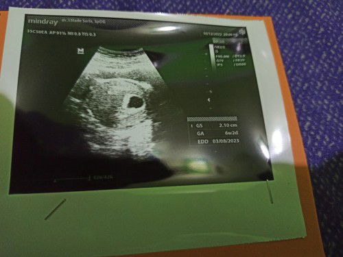 Usia Hpht 8w3d di usg mundur jadi 6w2d