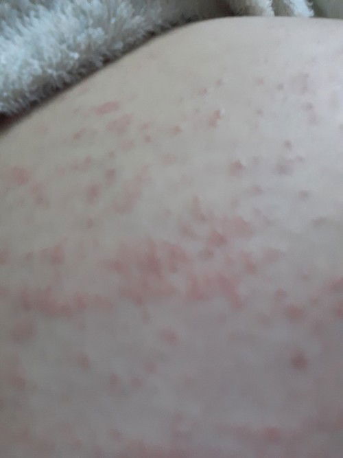 เปนผื่นขึ้นหน้าท้อง