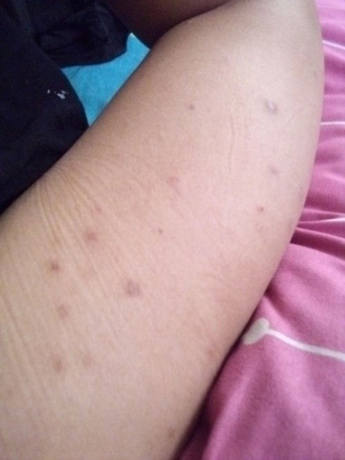 gatal gatal saat hamil