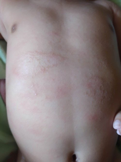 Ruam pada kulit bayi