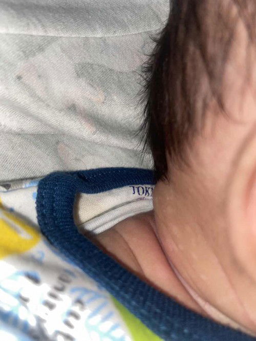 Bercak putih dileher bayi