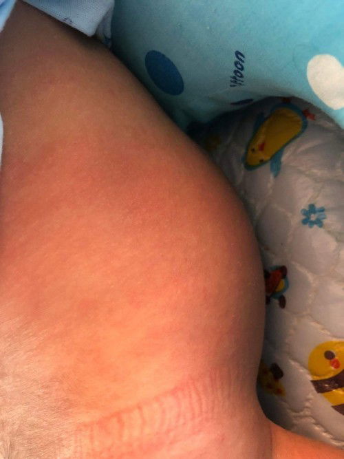 ลูกเป็นผื่นมีขลุยเต็มตัวเลยค่ะ1เดือนแล้วยังไม่หายทำอย่่างไรดีคะ