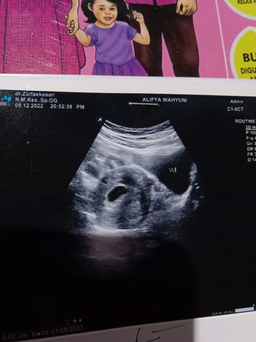 Ada yg sma nggak bund, hamil 6 week tpi janin belum kelihatan, masih kantung?