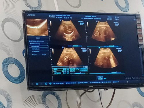 Bun mau tanya dong ini hbs USG pss janin tengkurap. Apkh bisa ke pss smlua?kalau bisa bagi tips dong