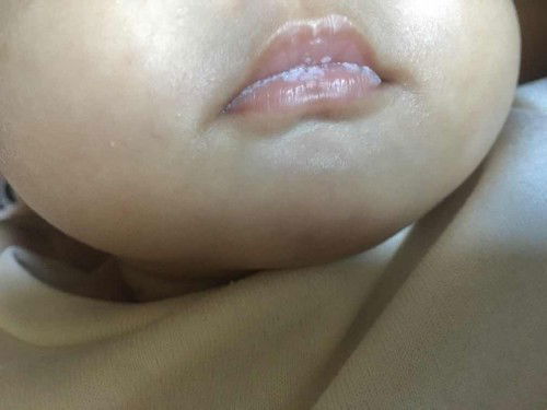 อยากถามแม่ๆที่ปากลูกเป็นเหมือนกันหน่อยค่ะ