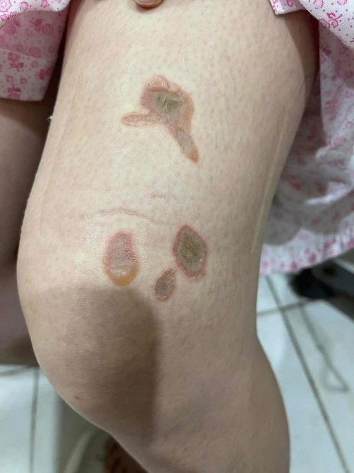 Streptococcus CS after Effect