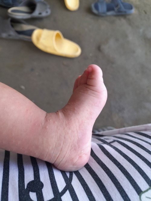 Any treatment for this?