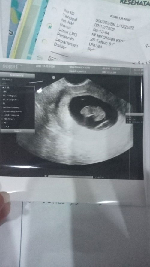 Mau tanya Bun apa ada hamil 9week3day
Tapi dibilang ga ada bilik jantung.. dan ga ada pergerakan bay