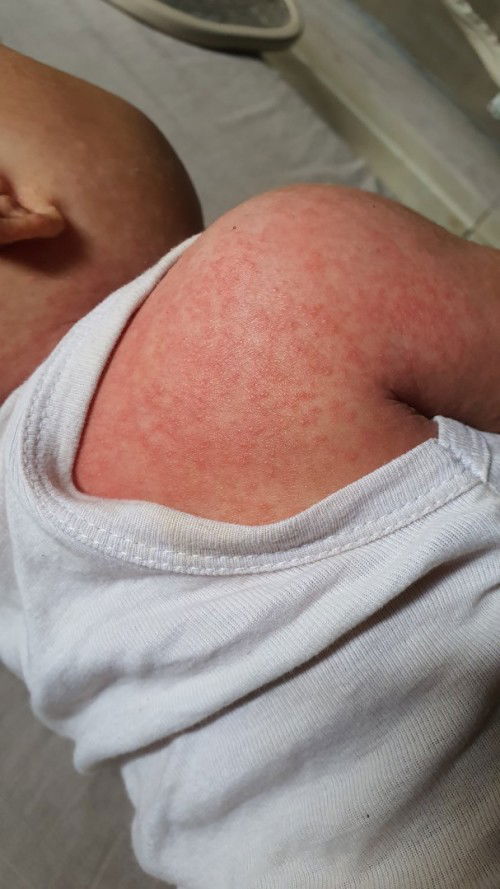 Ke dokter kulit arau ke dokter anak