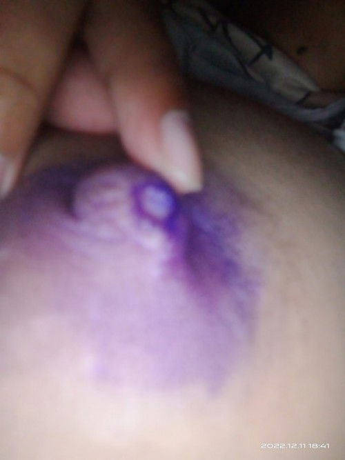 หัวนวแตกต้องใช้ยาอะไรมาค่ะ แล้วกี่วันหาย???