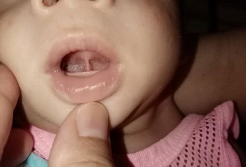 ขอสอบถามแม่ๆหน่อยค่ะ​ นี้ใช่พังผืดที่ใต้ลิ้นไหมค่ะ