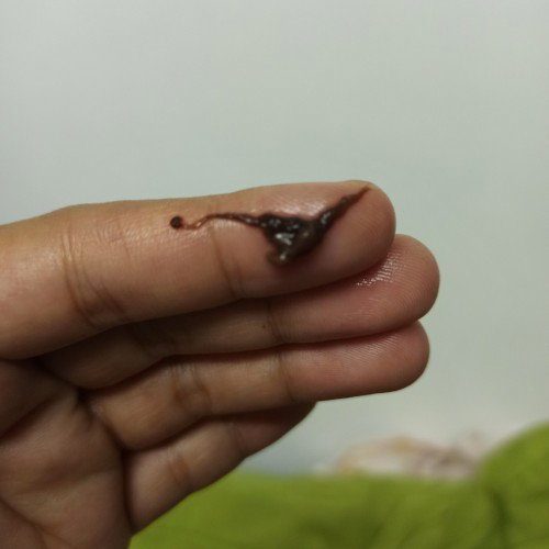 Brown discharge at Dugo after IE
