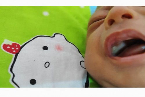 Putih di lelangit dan tepi gusi