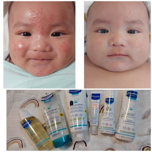 Baby acne/ Rashes/ Atopic-prone skin