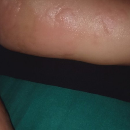Obat gatal" biduran pada anak apa ya mom. Tau" muncul begitu. Badan gk panas.