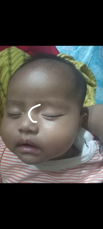 Sudut mata mengelupas