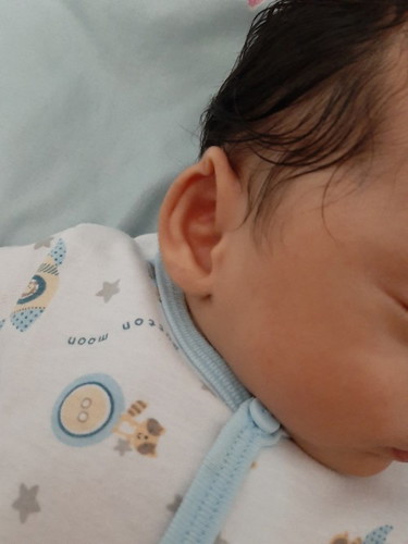 Daun telinga bayi terlipat