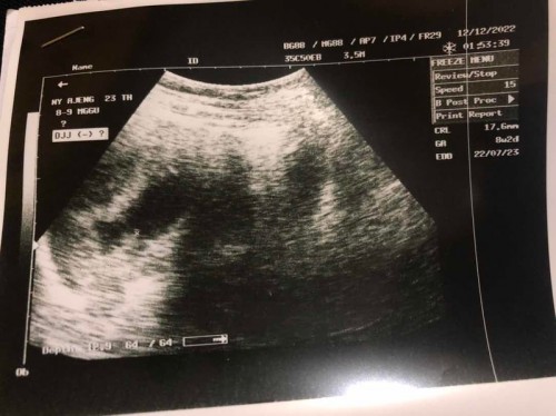 Hasil usg janin tidak berkembang