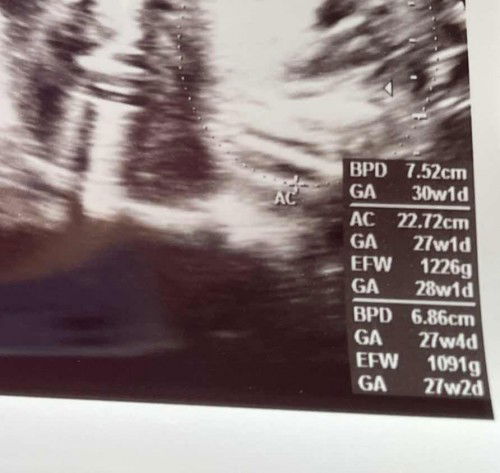 Umur dan berat janin