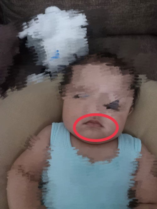 Puti puti sa gilid ng lips