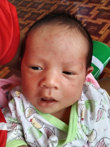หน้าลูกเป็นผดผื่น