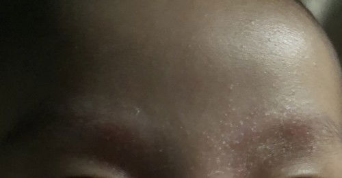 Nagbabalat sa kilay ni baby