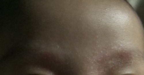 Nagbabalat sa kilay ni baby