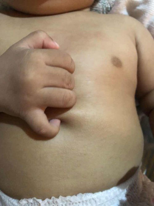 Seputar bintik” pada bayi