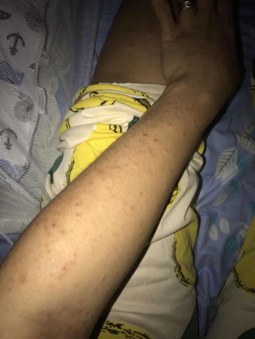 rashes after ko manganak