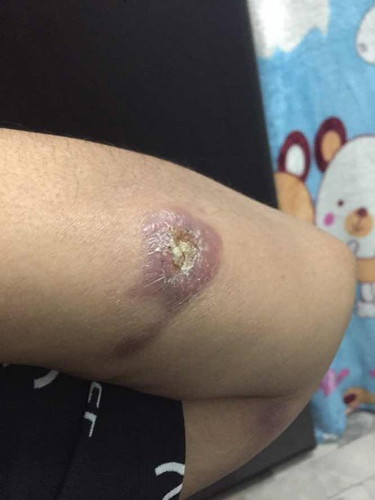 แผลแบบนี้คืออะไรค่ะ