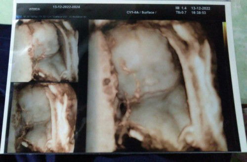 Suruh banyakin sujud karena bayi sungsang