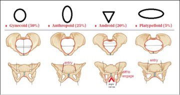 Peluang untuk VBAC tapi masih ragu-ragu dengan tulang pelvis