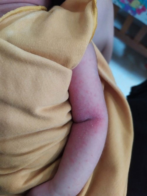 Bintik merah pada bayi