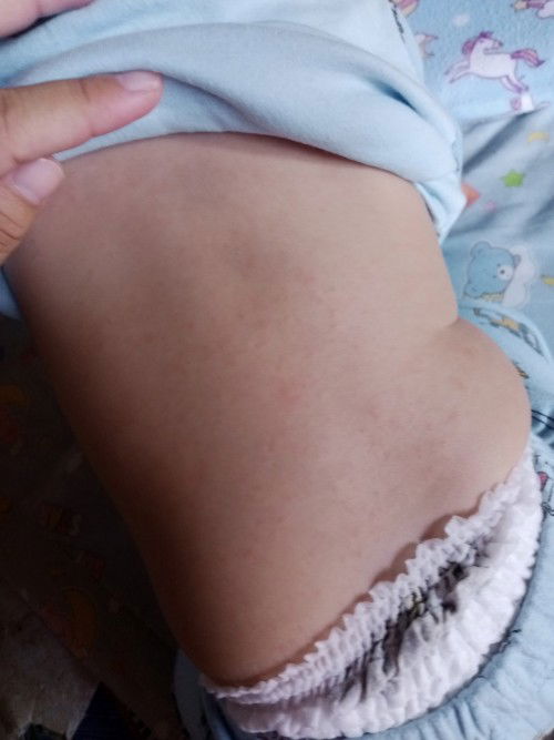 ผื่นขึ้นเต็มหลังลูก