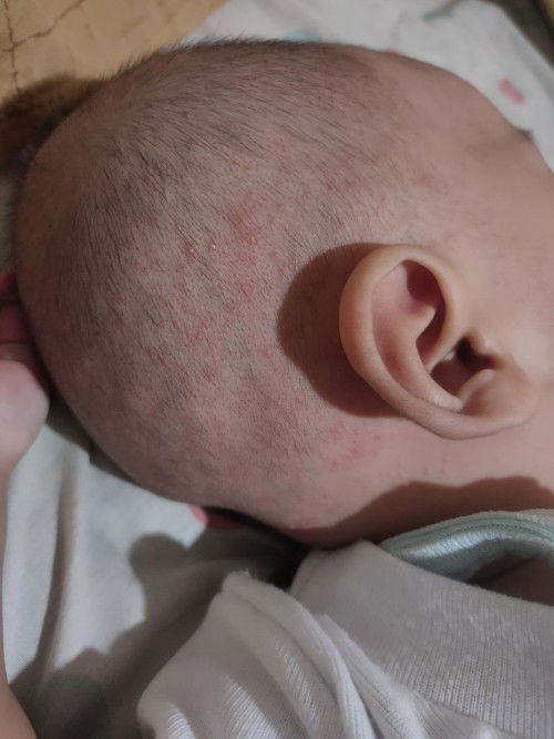 Bun ini knp ya kepala anak saya disampunh merah GT bahaya GK ya??