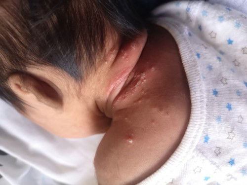 แผลแบบนี้ดูแลน้องยังไงบ้างคะแม่ๆ