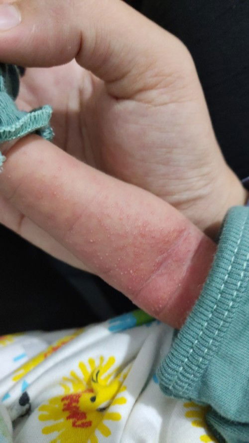 Kulit bayi berubtus merah