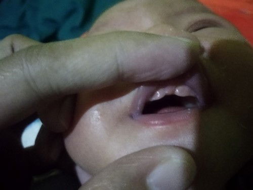 Bedanya tongue tie sama lip tie