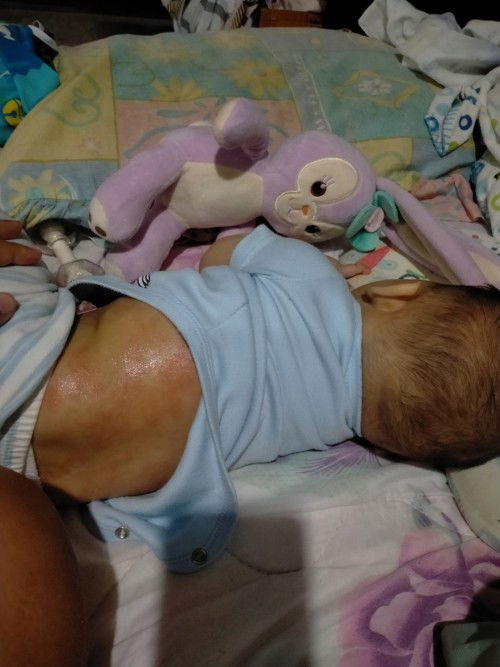 อาการแพ้ผื่นเต็มตัว ตอนนี้เครียมาดมากๆเลยคะ