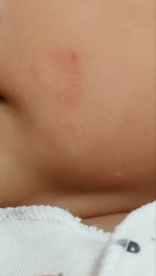 Kulit bayi seperti gatal di pipi