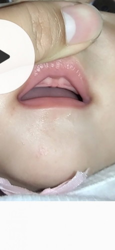 5 month old
gums