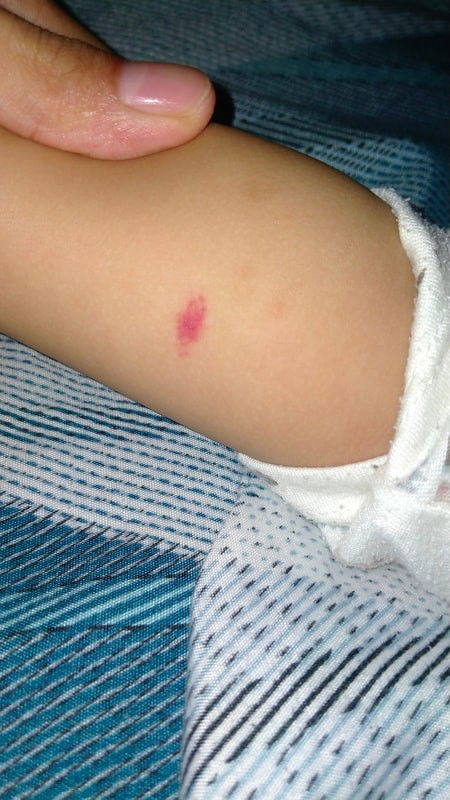 Bekas bentol seperti memar merah