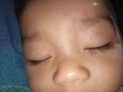 ผื่นขึ้นรอบตาลูก🥺