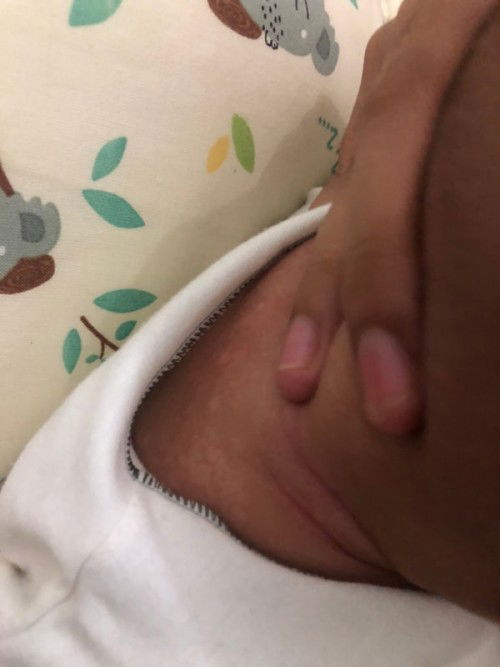 kulit bayi ngelupas putih