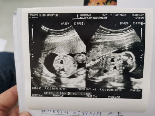 ตั้งครรภ์21วีค​ ตรวจเจอว่าน้องไตบวม