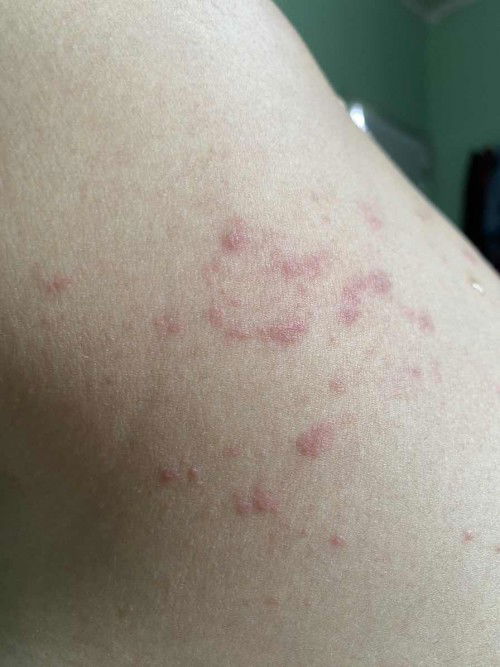 Gatal dan perih di daerah punggung dan dada