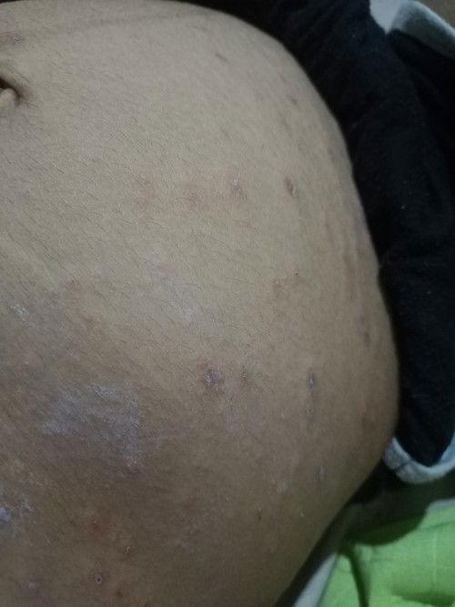 Bruntussan Merah Gatal Saat Hamil